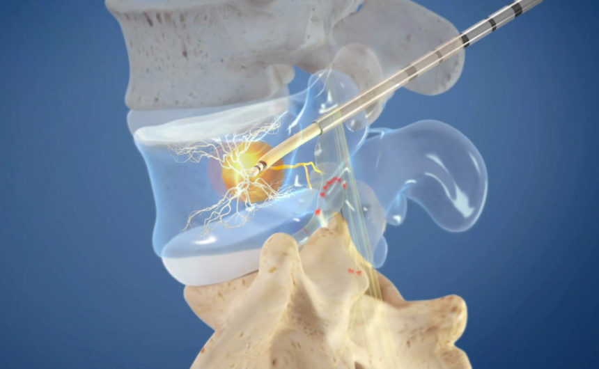 Relieve Pain Center to Offer Breakthrough Treatment for Patients with Chronic Low Back Pain Relieve Pain Center to Offer Breakthrough Treatment for Patients with Chronic Low Back Pain